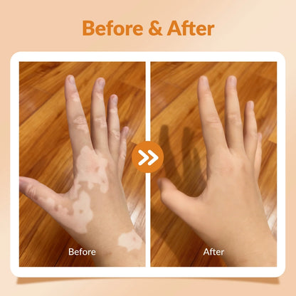 Handheld 308nm Laser UVB Light Therapy At Home For Vitiligo and Psoriasis