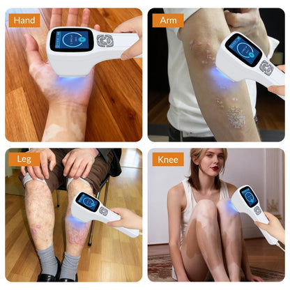 Handheld 308nm Laser UVB Light Therapy At Home For Vitiligo and Psoriasis
