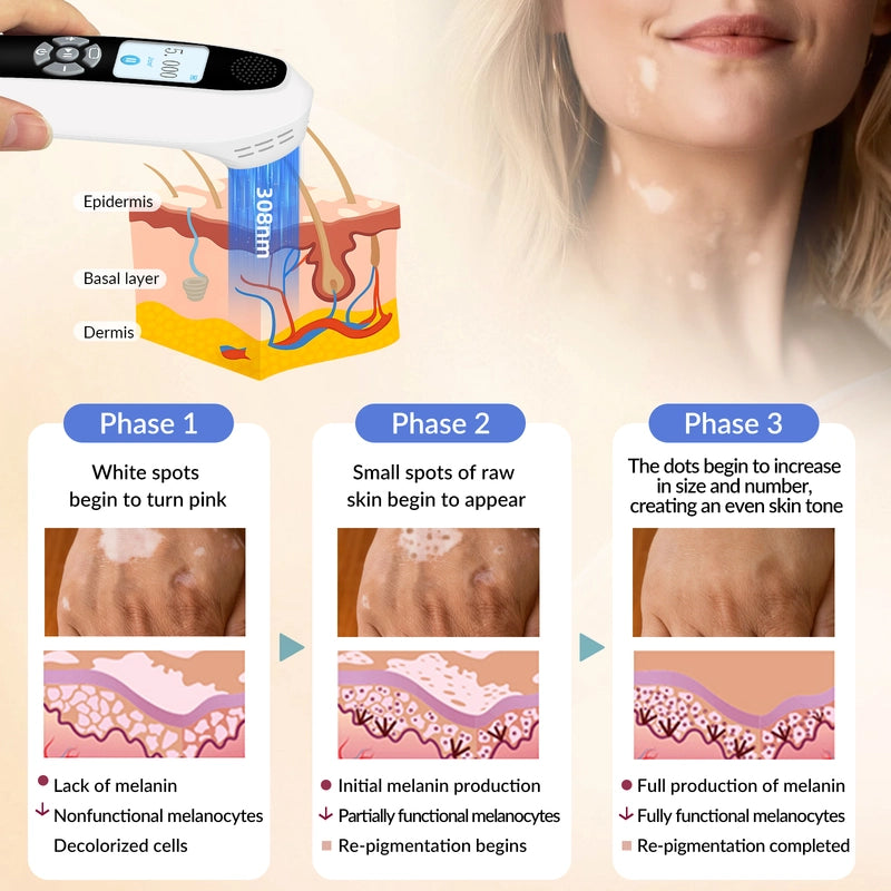 Portable 308nm UVB Phototherapy Device – Effective for Vitiligo & Psoriasis at Home