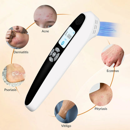 Portable 308nm UVB Phototherapy Device – Effective for Vitiligo & Psoriasis at Home